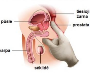 prostatos operacija erekcijos atstatymas