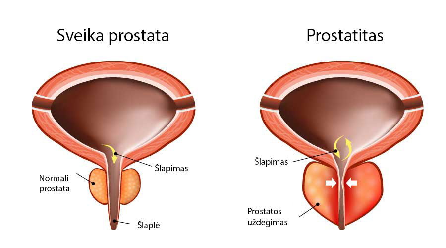 prostatito erekcijos simptomai
