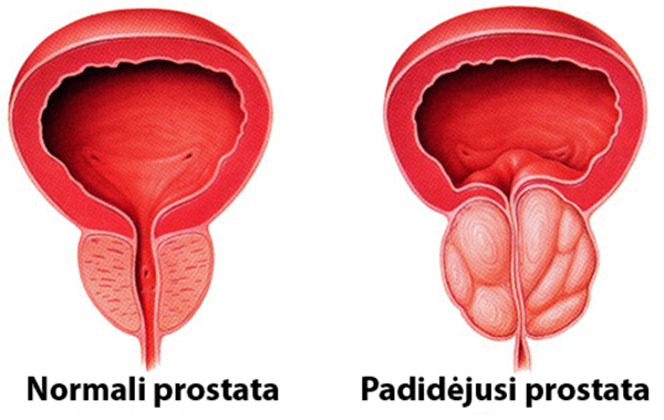 erekcijos prostata
