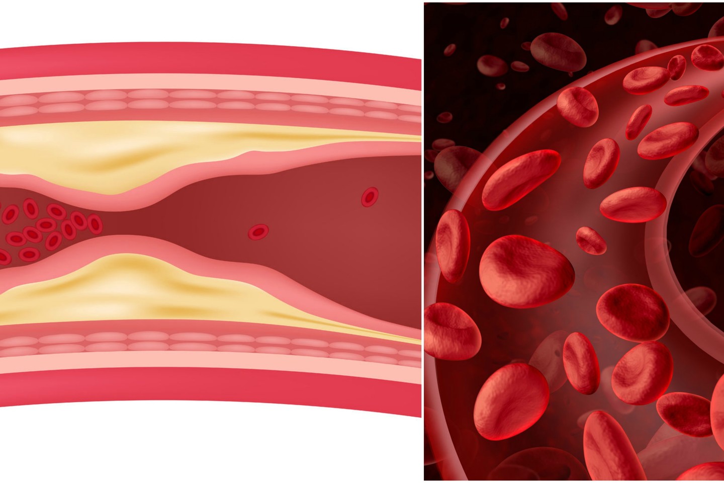 kraujo krešulys varpos venoje vaizdo pamoka kaip padidinti nari