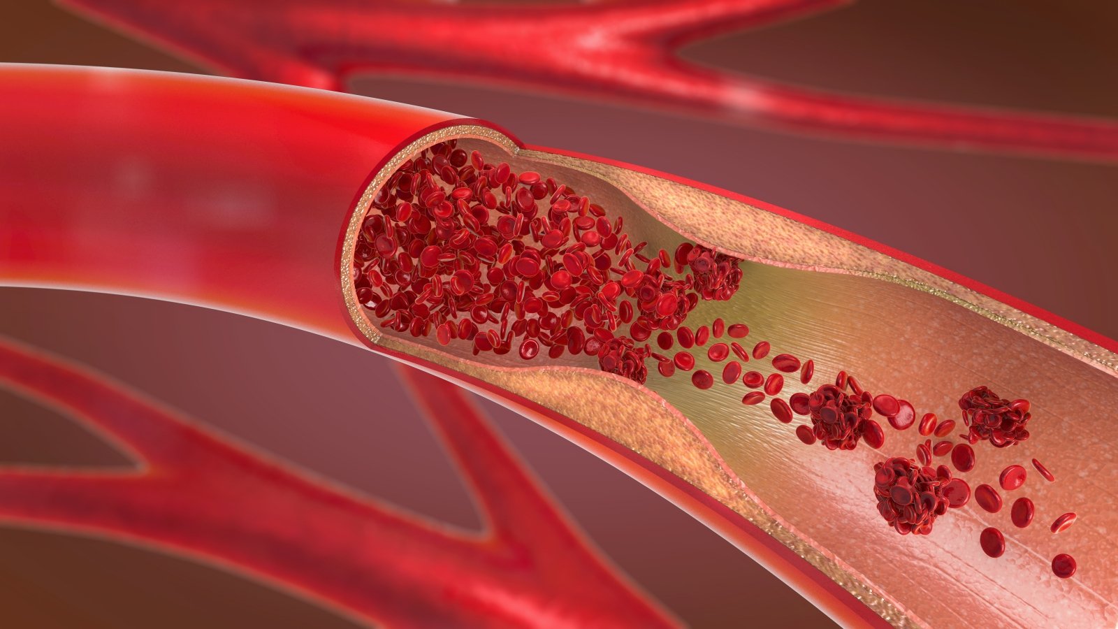 kraujo krešulys varpos venoje ar po prostatos masažo pagerėja erekcija